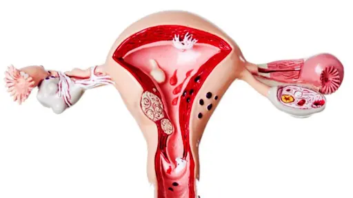 Đau bụng kinh dữ dội là dấu hiệu điển hình của bệnh lạc nội mạc tử cung